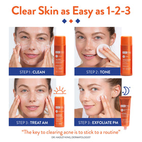 AcneFree 10% benzoyl peroxide lotion pump showing treatment strength for blemishes