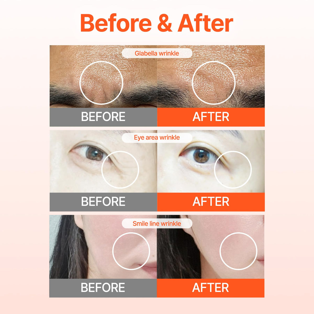 Acropass RETI-RN patch applied at eye corner demonstrating targeted use