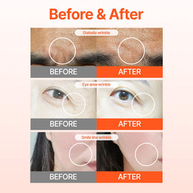Patch applied near eye area showing Acropass discreet fit and comfort