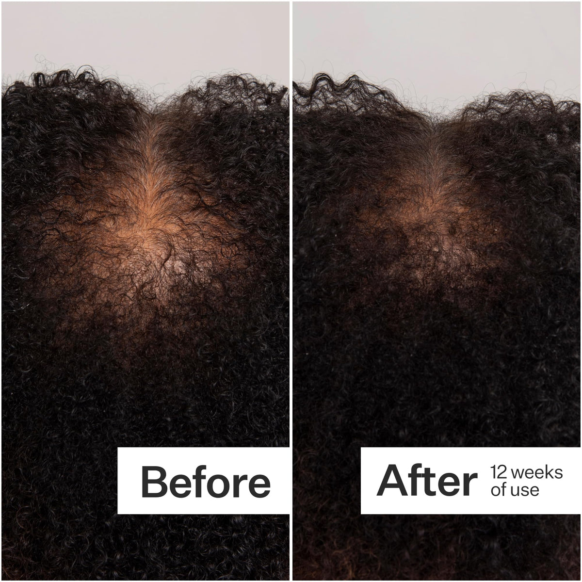 ACT+ ACRE dermastamp in use on scalp demonstrating targeted application and routine pairing