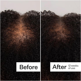 ACT+ ACRE dermastamp in use on scalp demonstrating targeted application and routine pairing