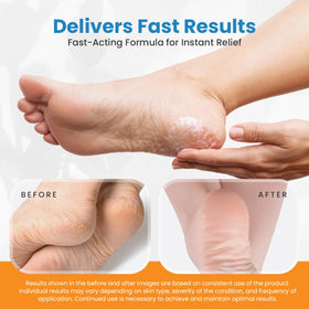 activelife Revitaderm application on heel improving rough skin
