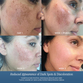 Admire My Skin before and after composite showing reduced spot visibility over time