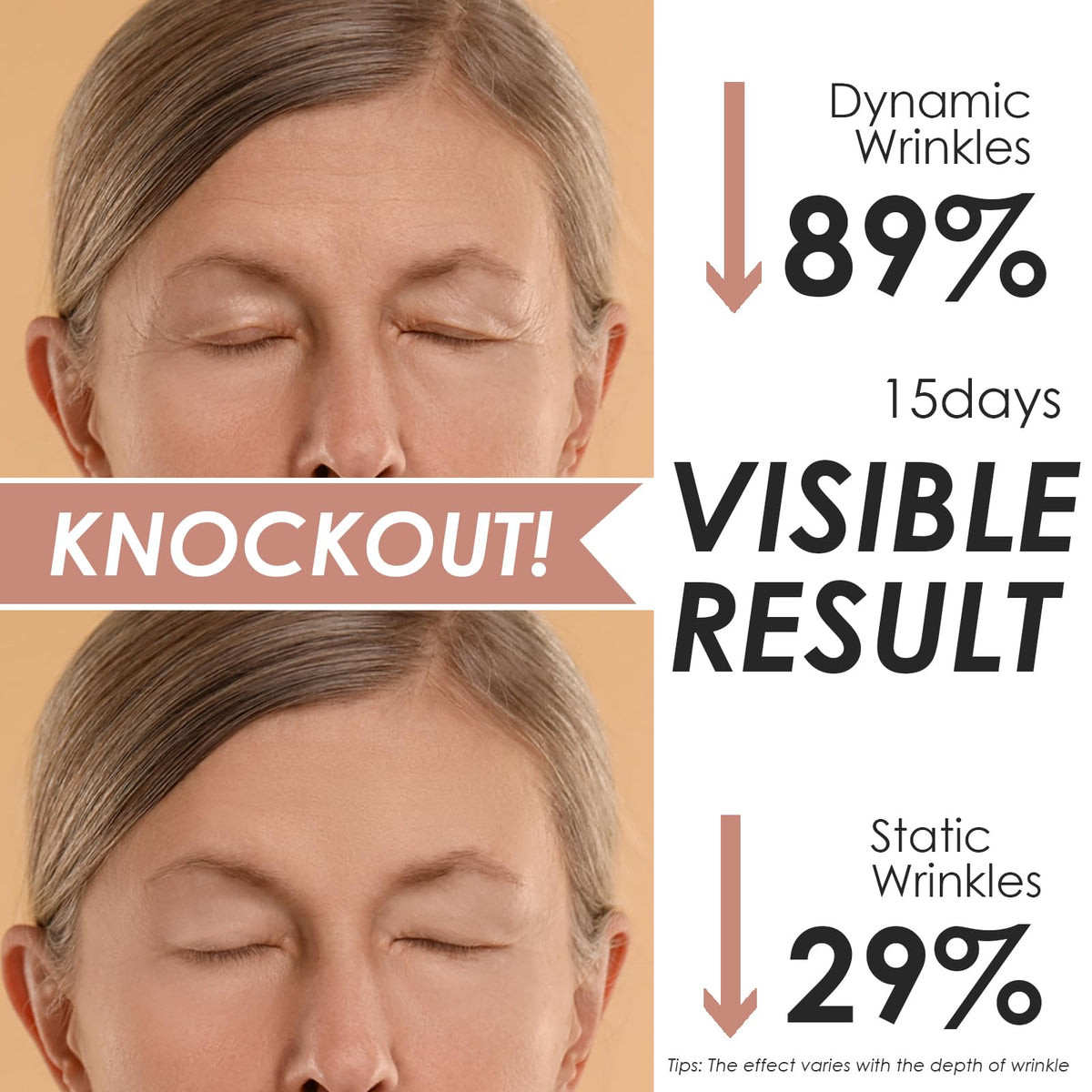 akissos before and after comparison showing smoother forehead