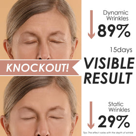 akissos before and after comparison showing smoother forehead
