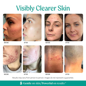 Almond Clear mandelic acid graphic highlighting ingredient and gentle exfoliation benefit