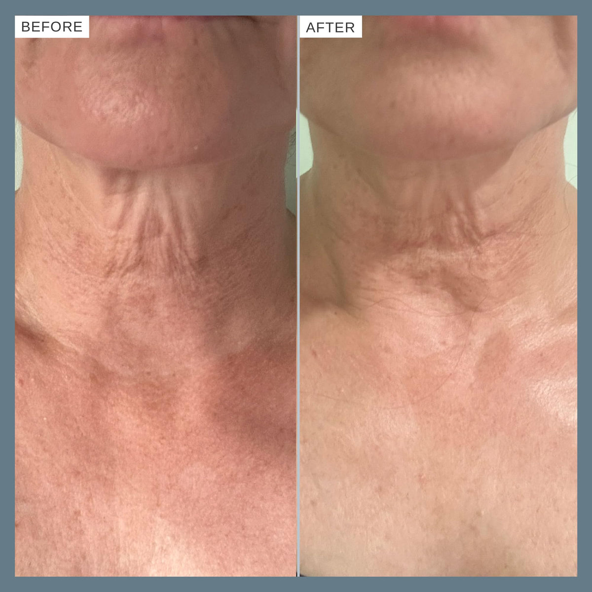 Alpha-H applied to forearm showing improved texture and visible softness