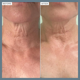 Alpha-H applied to forearm showing improved texture and visible softness