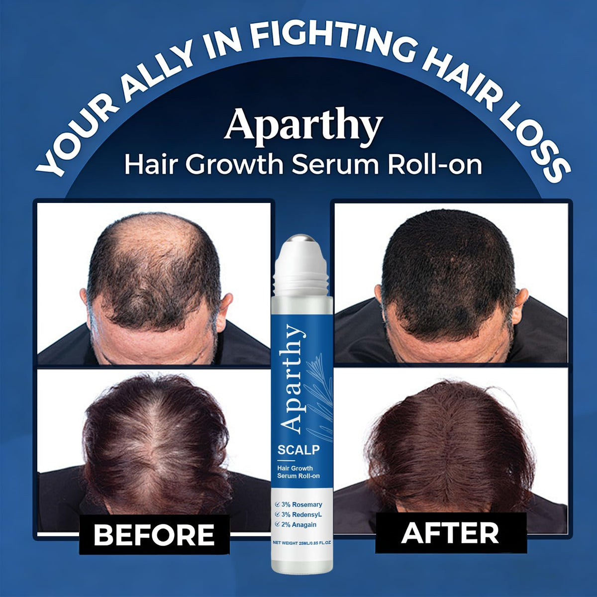 Aparthy rollerball close-up demonstrating precise application and targeted scalp benefit