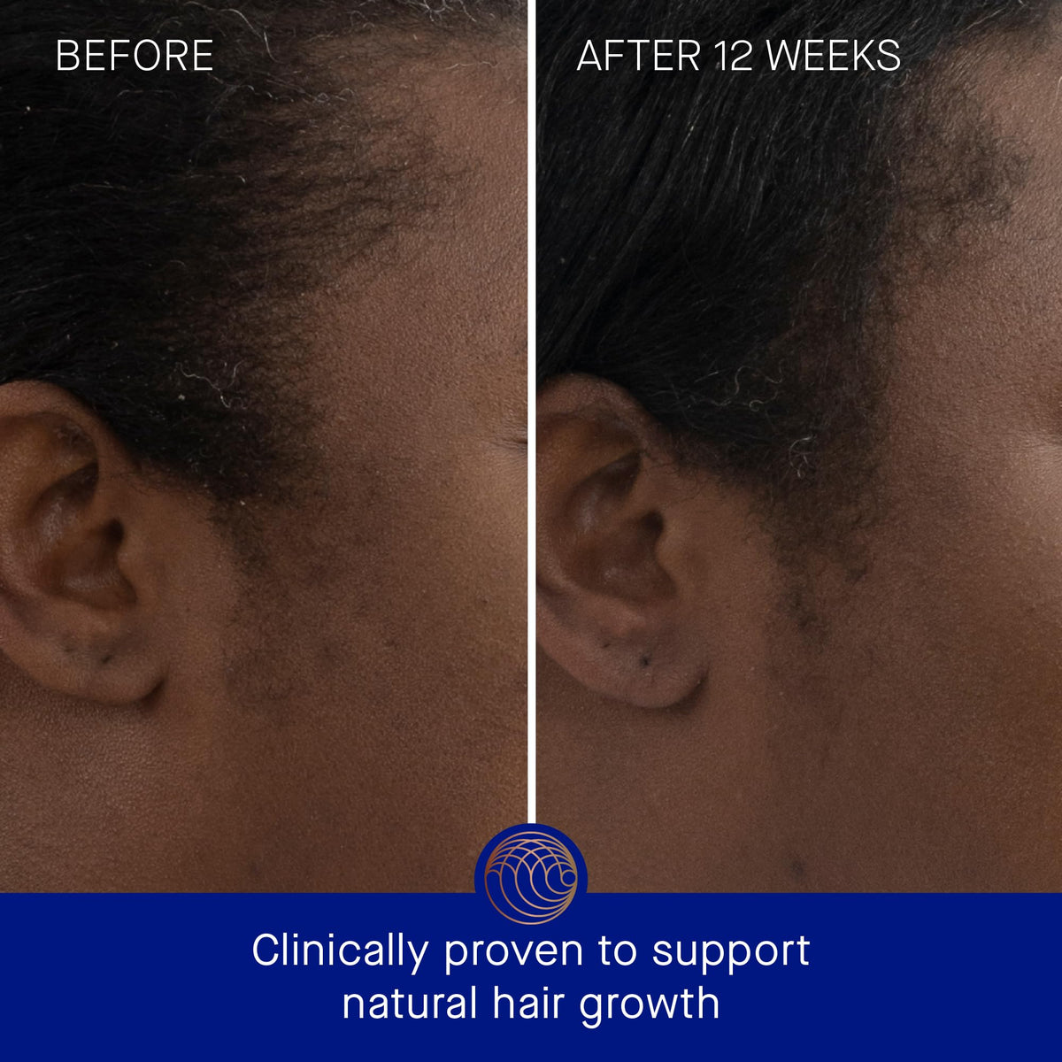 Augustinus Bader dropper applying serum to scalp for precise treatment