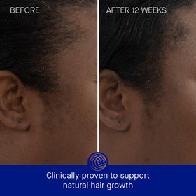 Augustinus Bader dropper applying serum to scalp for precise treatment