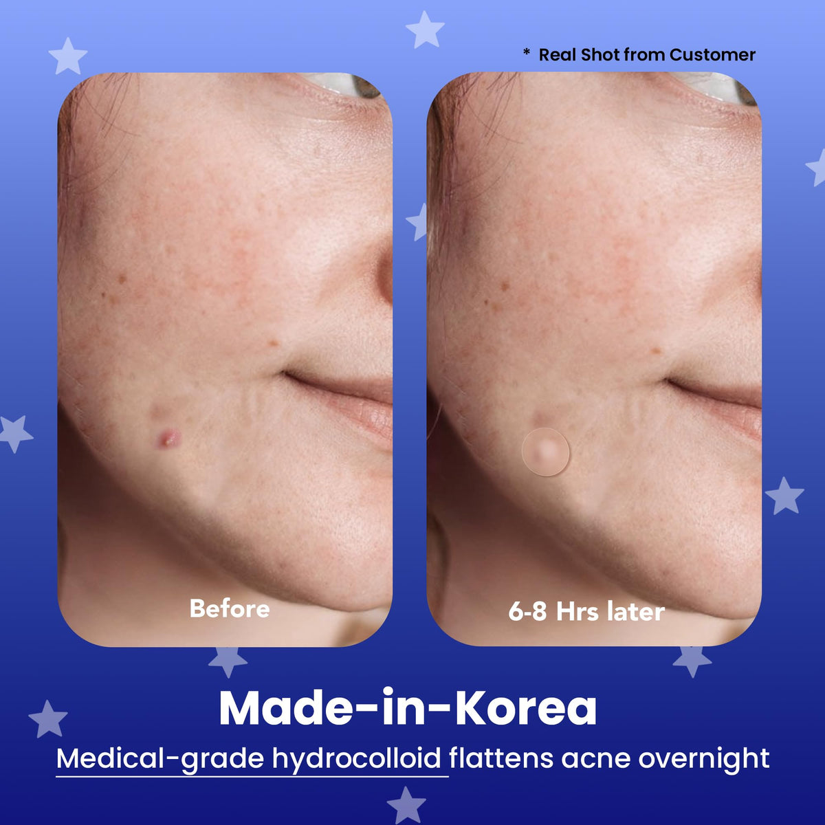 AVARELLE close-up of hydrocolloid patch texture showing absorbent surface benefit