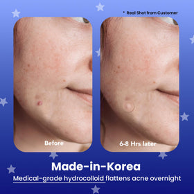 AVARELLE close-up of hydrocolloid patch texture showing absorbent surface benefit