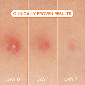 Biore patch used at night on pillow showing overnight absorbency benefit