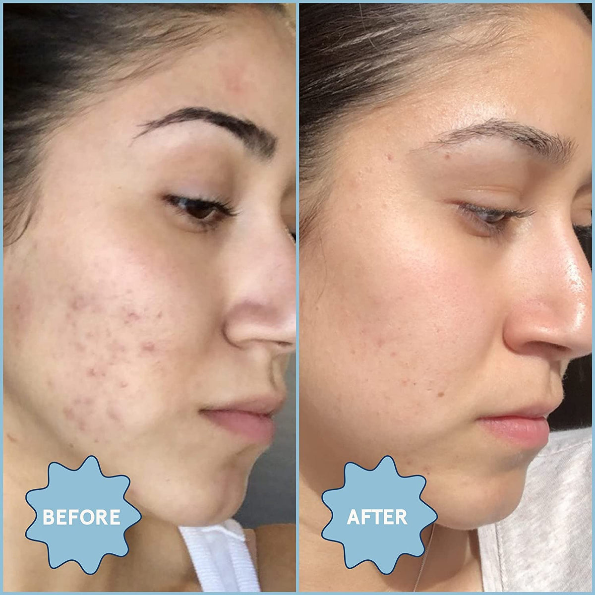 Blume Meltdown mixed into moisturizer for broader blemish prevention