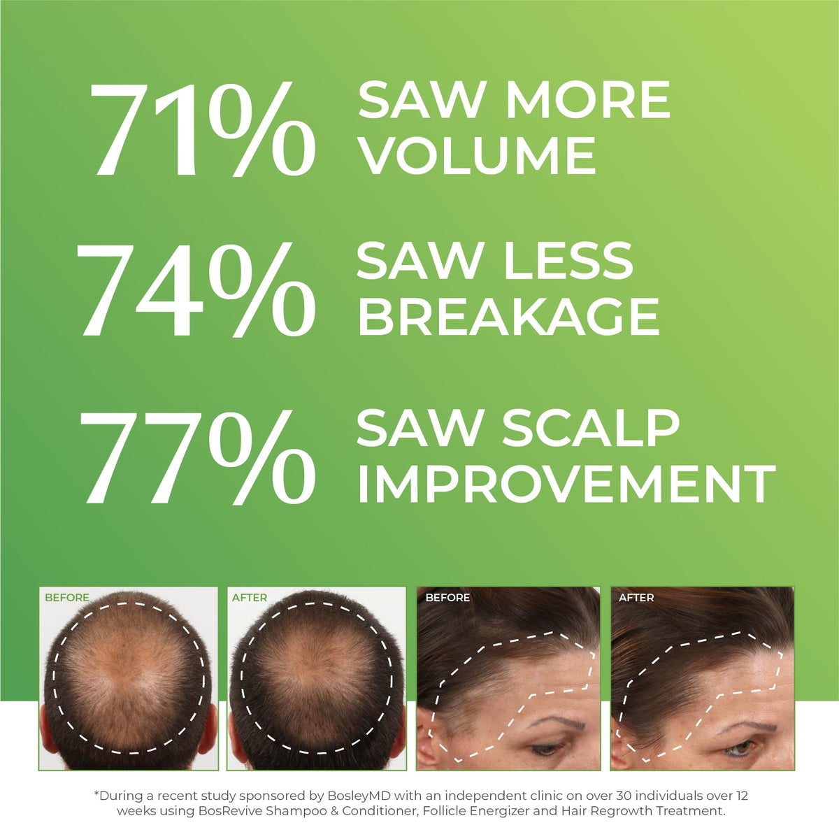 BosleyMD application on scalp demonstrating targeted delivery benefit