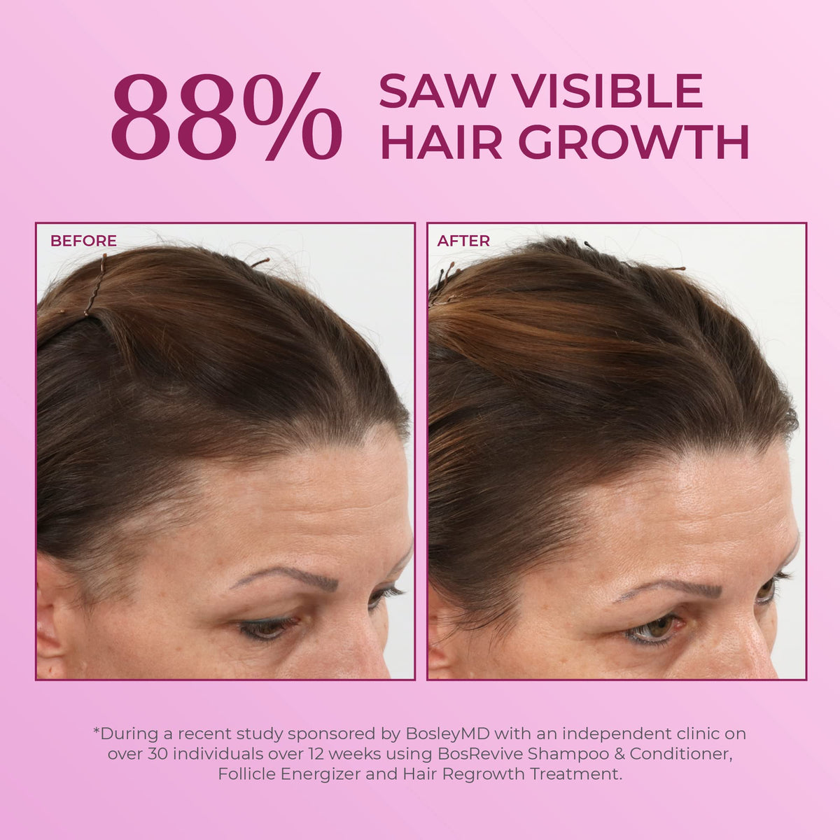 BosleyMD solution texture in hand demonstrating easy spray absorption