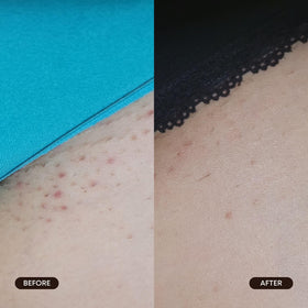 bushbalm pad used on bikini area to help reduce ingrown hairs