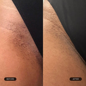 Bushbalm pad being applied to underarm demonstrating targeted ingrown hair care
