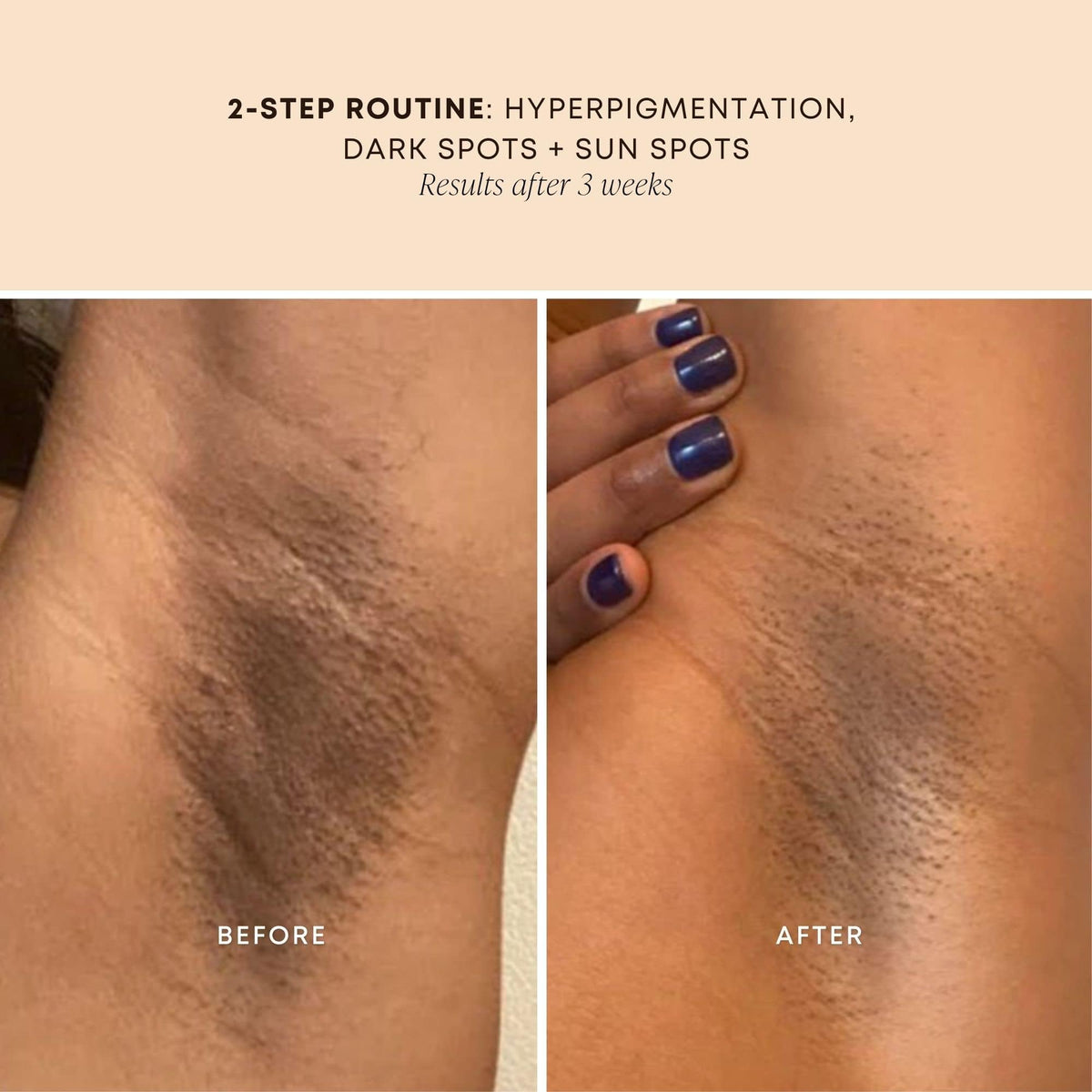 bushbalm applied to bikini line to reduce ingrown hairs