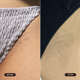 Bushbalm applied to bikini line showing gentle post-hair removal care