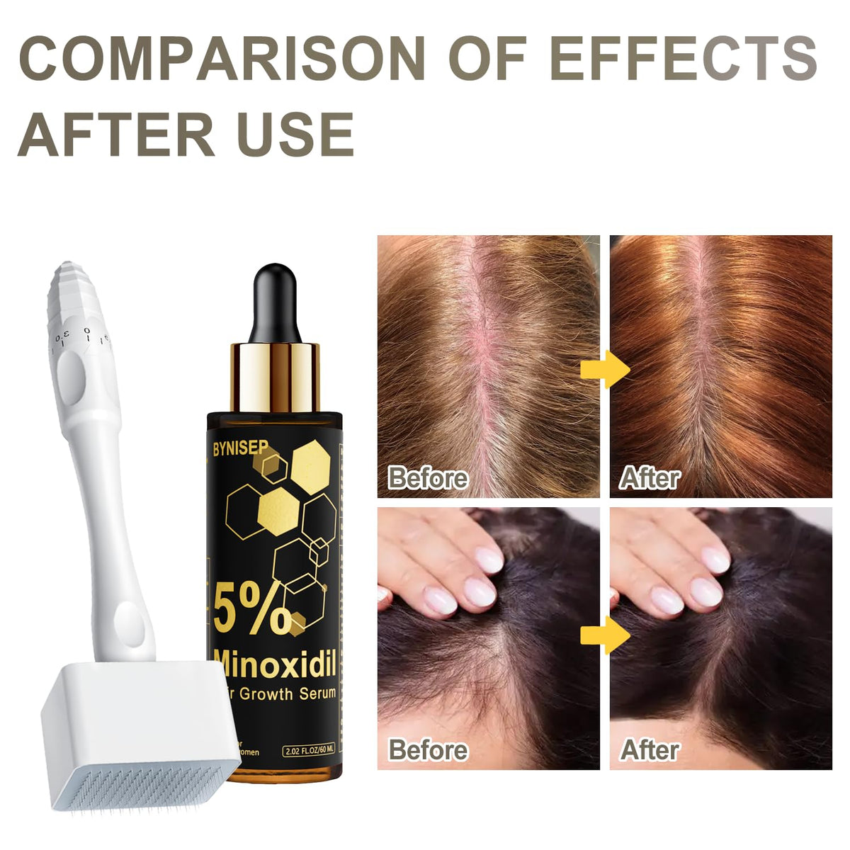 BYNISEP applied to thinning scalp area showing easy topical use