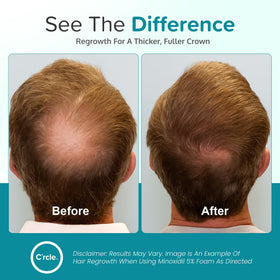 C'rcle foam applied to male vertex scalp demonstrating targeted coverage benefit