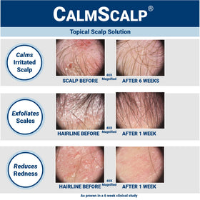 CalmScalp amber bottle close-up, highlights clean design and easy dispensing