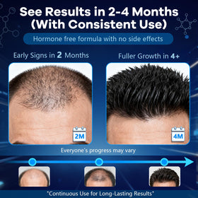 CARENICE application on scalp showing easy twice-daily use