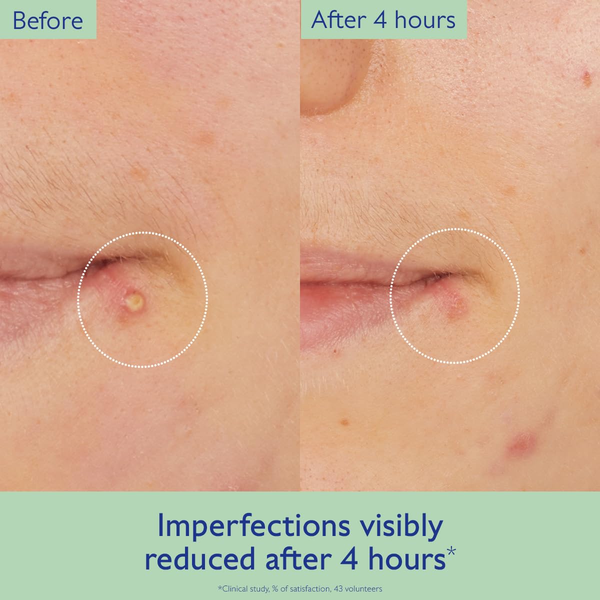 Caudalie Vinopure being applied on fingertip to target a spot for quick reduction