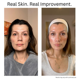 Applying Cellure serum to cheek to show targeted plumping and smoothing benefit