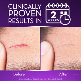 Cicatricure applied to a healed scar demonstrating smoother appearance