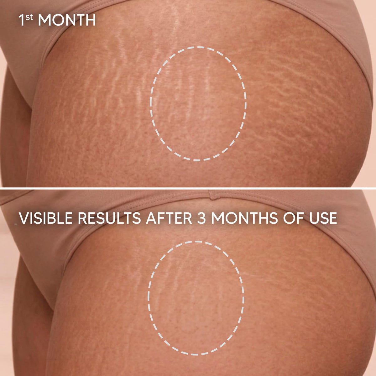Cicatrissim being applied to thigh to illustrate massage technique and coverage
