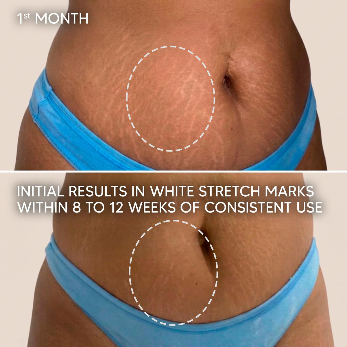Cicatrissim tube beside ruler showing 5.3 oz scale benefit
