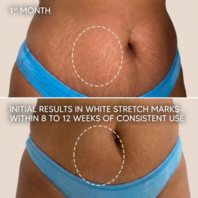 Cicatrissim tube beside ruler showing 5.3 oz scale benefit