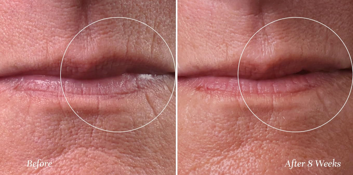 City Beauty applying Line Therapy to upper lip demonstrating targeted smoothing benefit