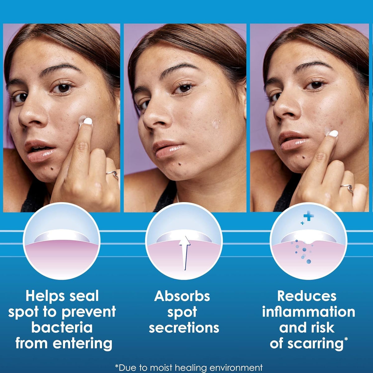 Clearasil patch applied on cheek offering discreet protection