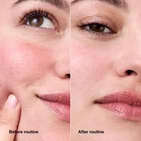 Clinique before-and-after styled image showing reduced visible redness