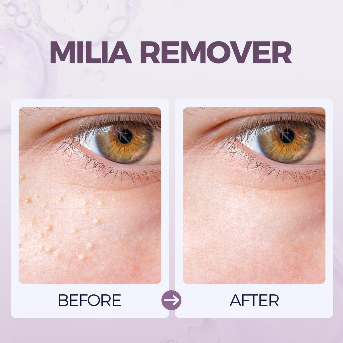 Cokdsid applied under-eye showing precise application and gentle control