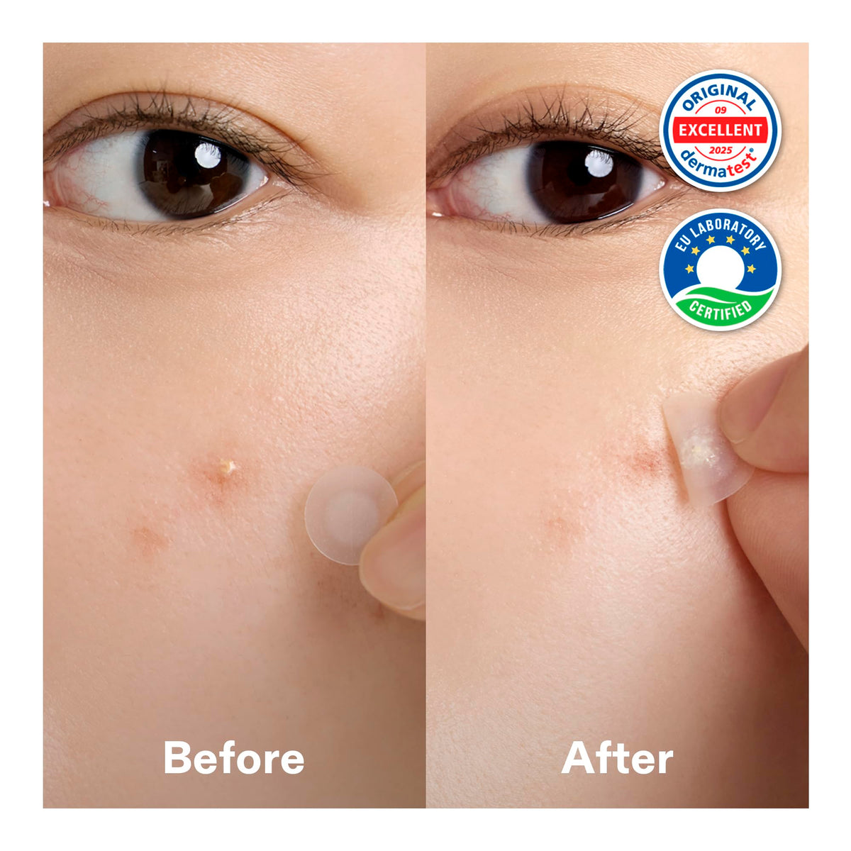 Cordiale close-up of hydrocolloid center absorbing impurities