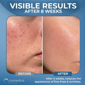 Cosmedica serum being applied to cheek demonstrating quick absorption