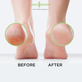 daily remedy before and after softened callus transformation