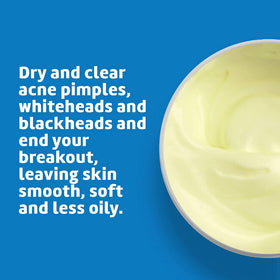 De La Cruz applied on cheek as targeted spot treatment for pimples