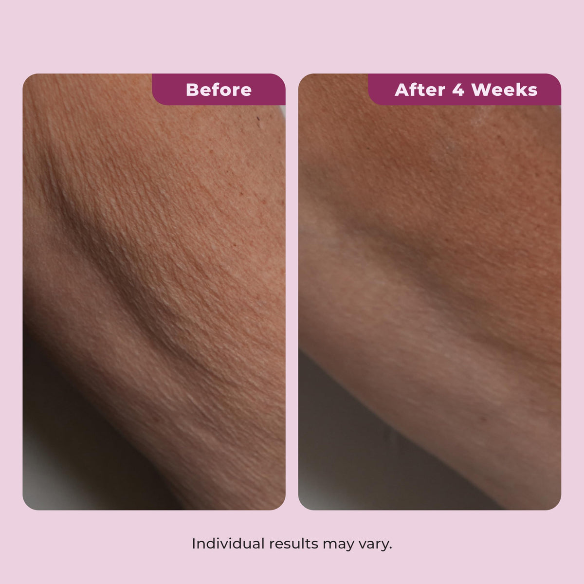 DEKLIDERM illustrated before and after neck to show firmer, smoother appearance benefit