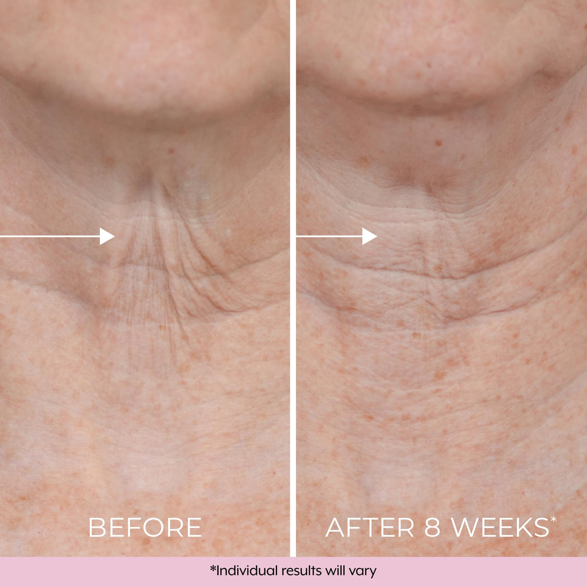 DEKLIDERM applied to décolleté in lifestyle shot showing natural-looking smoothing benefit