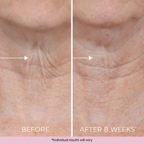 DEKLIDERM applied to décolleté in lifestyle shot showing natural-looking smoothing benefit