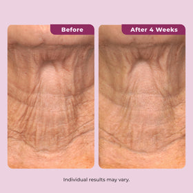 DEKLIDERM jar open with visible ingredients emphasizing retinol and bakuchiol benefit