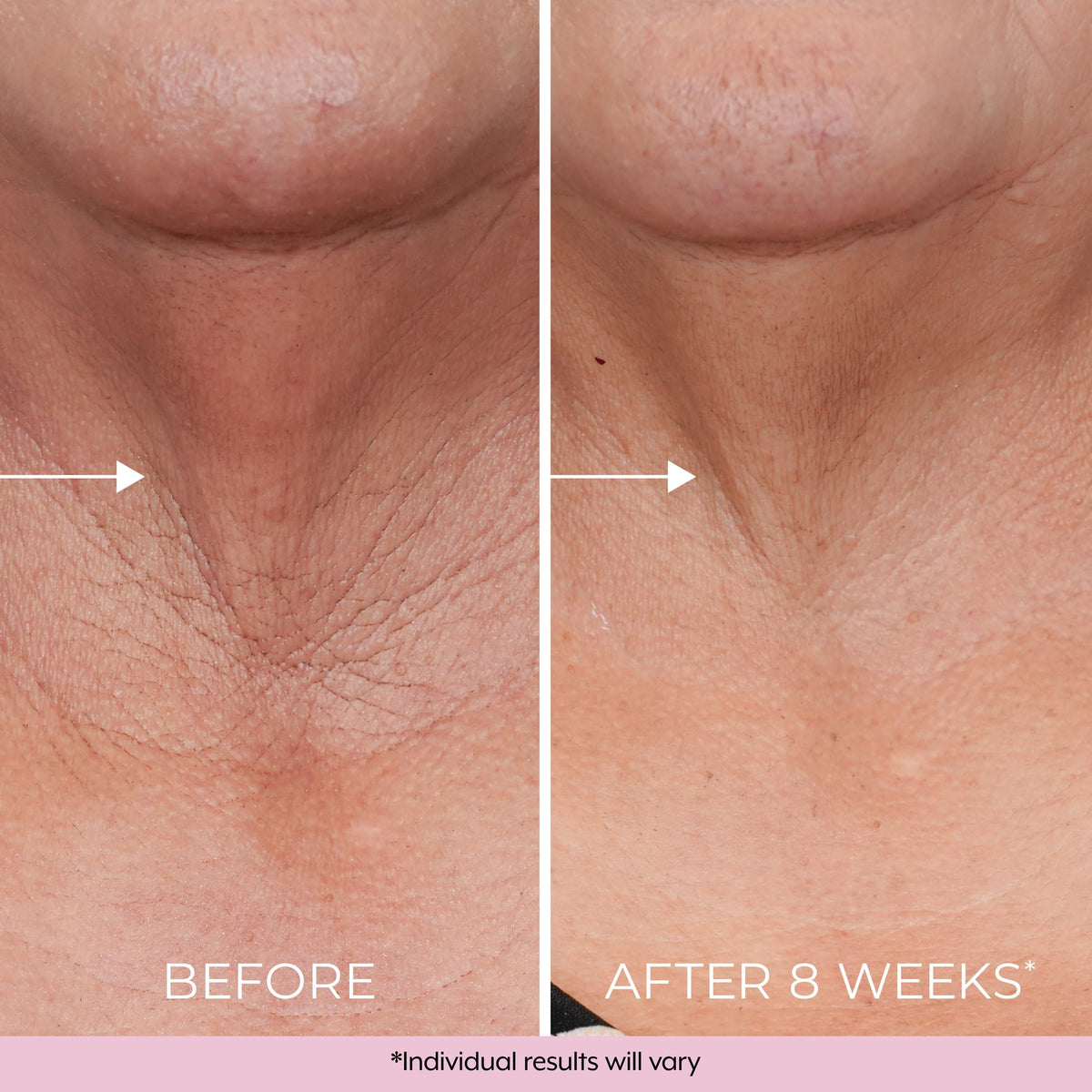 DEKLIDERM on upper arm next to ruler showing improved crepey skin texture benefit