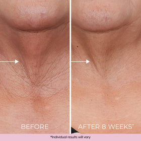 DEKLIDERM on upper arm next to ruler showing improved crepey skin texture benefit