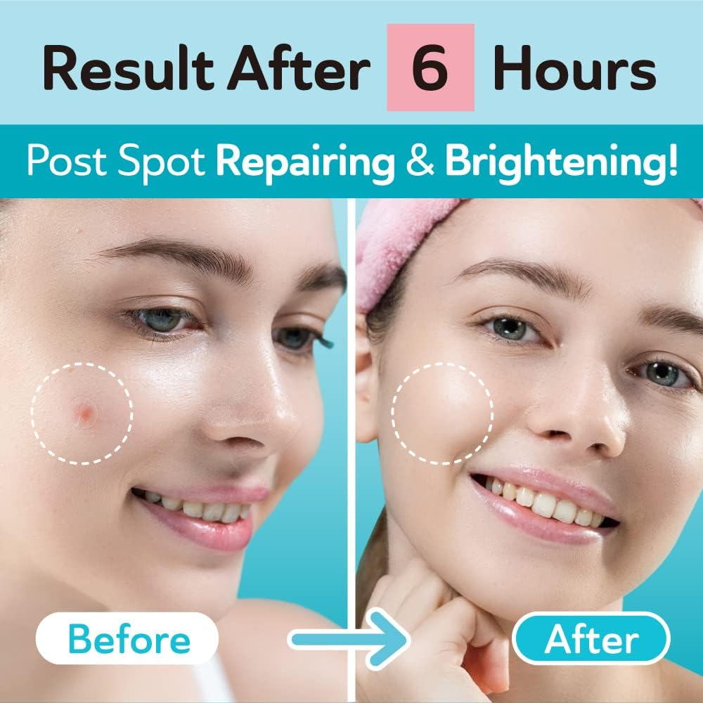 DERMA ANGEL absorption demo showing hydrocolloid drawing fluid away from blemish